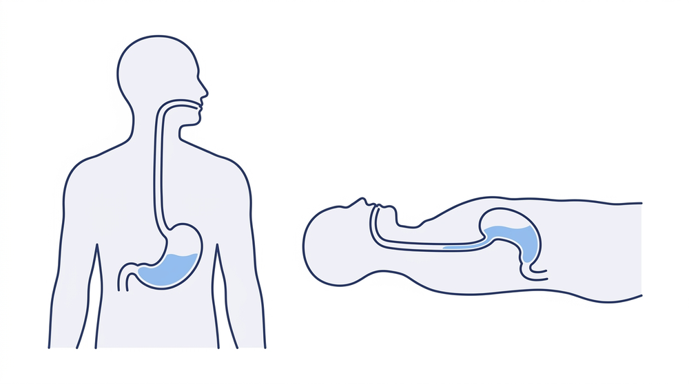 Diagram comparing stomach contents upright versus lying down